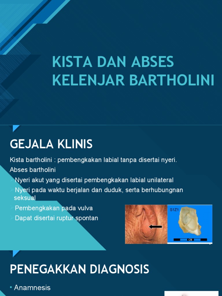 Kista Dan Abses Kelenjar Bartholini