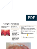 Faringitis