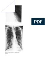 Bronchiectasis. Tramline Shadows Are Visible Through The Heart Shadow