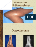 Osteosarcoma DR: Gehan Mohamed