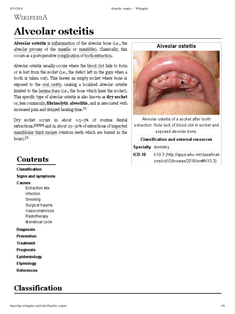 Alveolar Osteitis Wikipedia PDF Dentistry Dentistry Branches