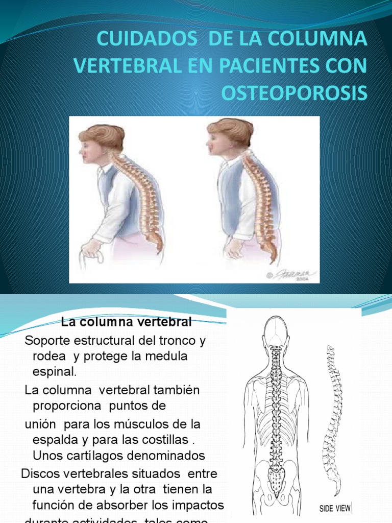 Cuidados de La Columna Vertebral en Pacientes Con | PDF | Osteoporosis ...