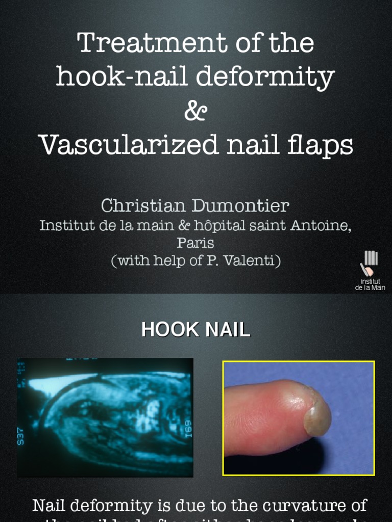 2 HookNail Treatment PDF PDF Medical Specialties Surgery