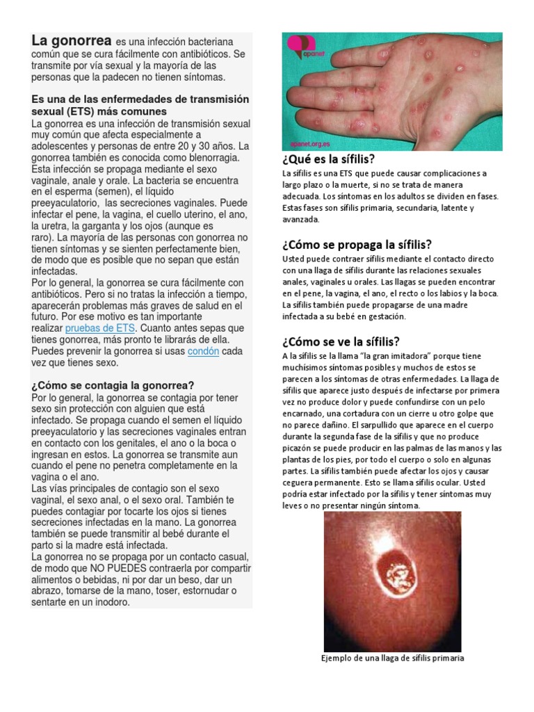 La Gonorrea Vih Sida Infeccion Transmitida Sexualmente