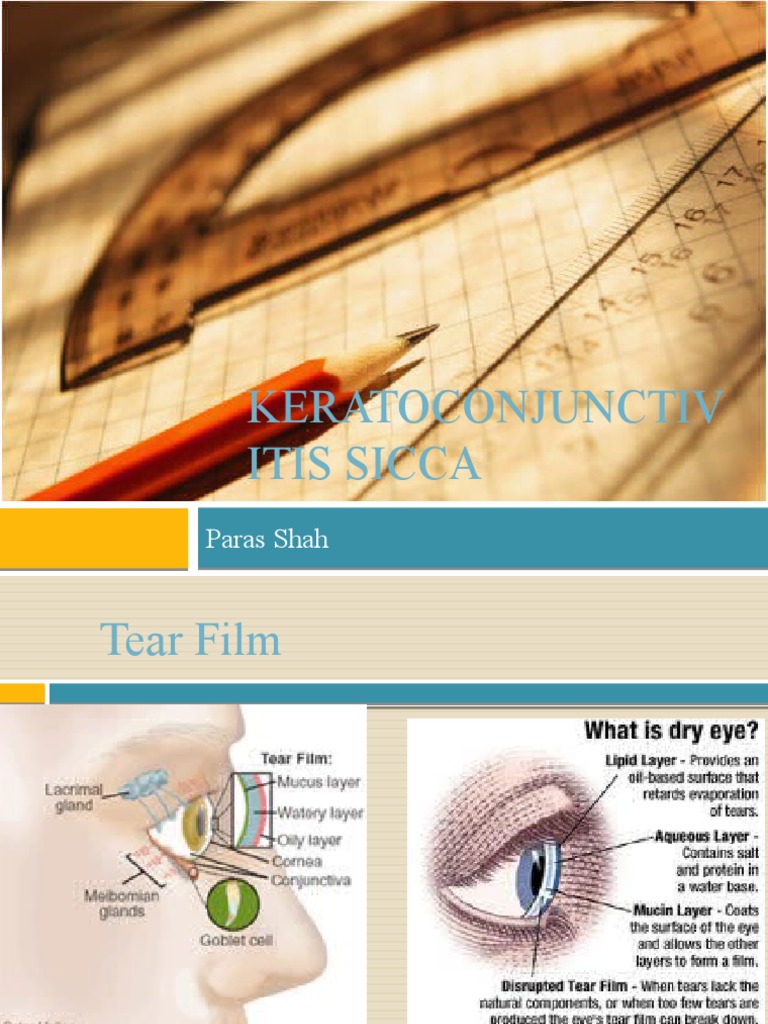 Keratoconjunctivitis Sicca Final | PDF | Medical Specialties | Health ...