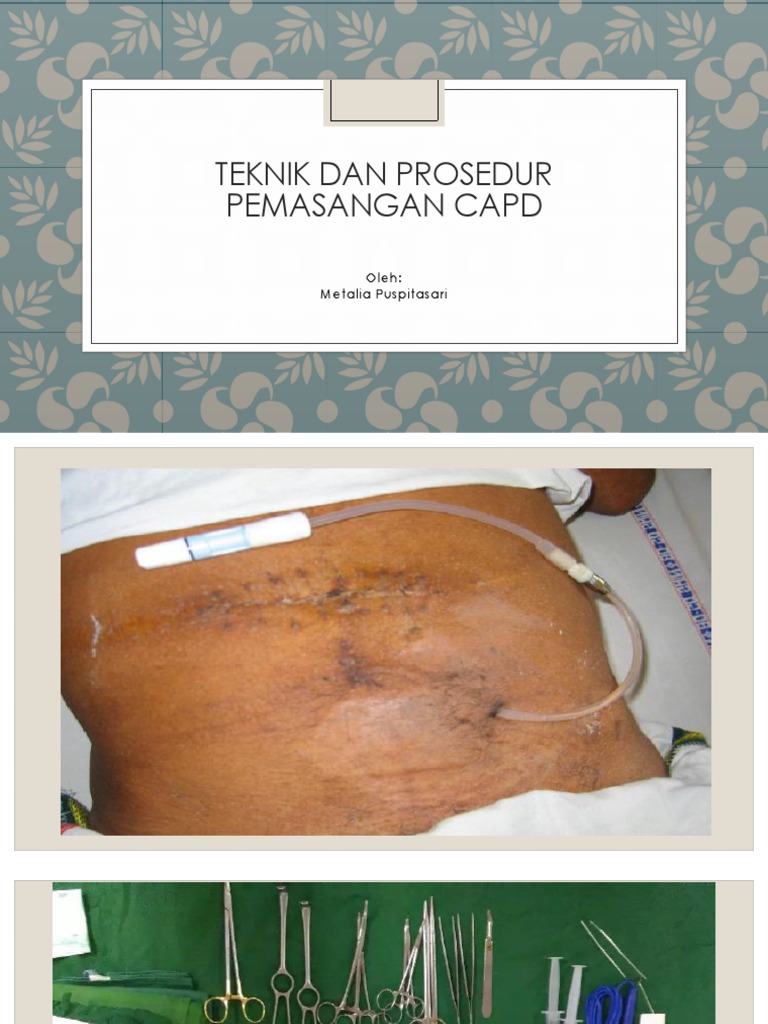 Prosedur Pemasangan CAPD yang Aman | PDF