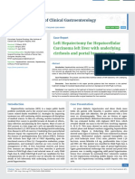 Left Hepatectomy For Hepatocellular Carcinoma Left Liver With Underlying Cirrhosis and Portal Hypertension