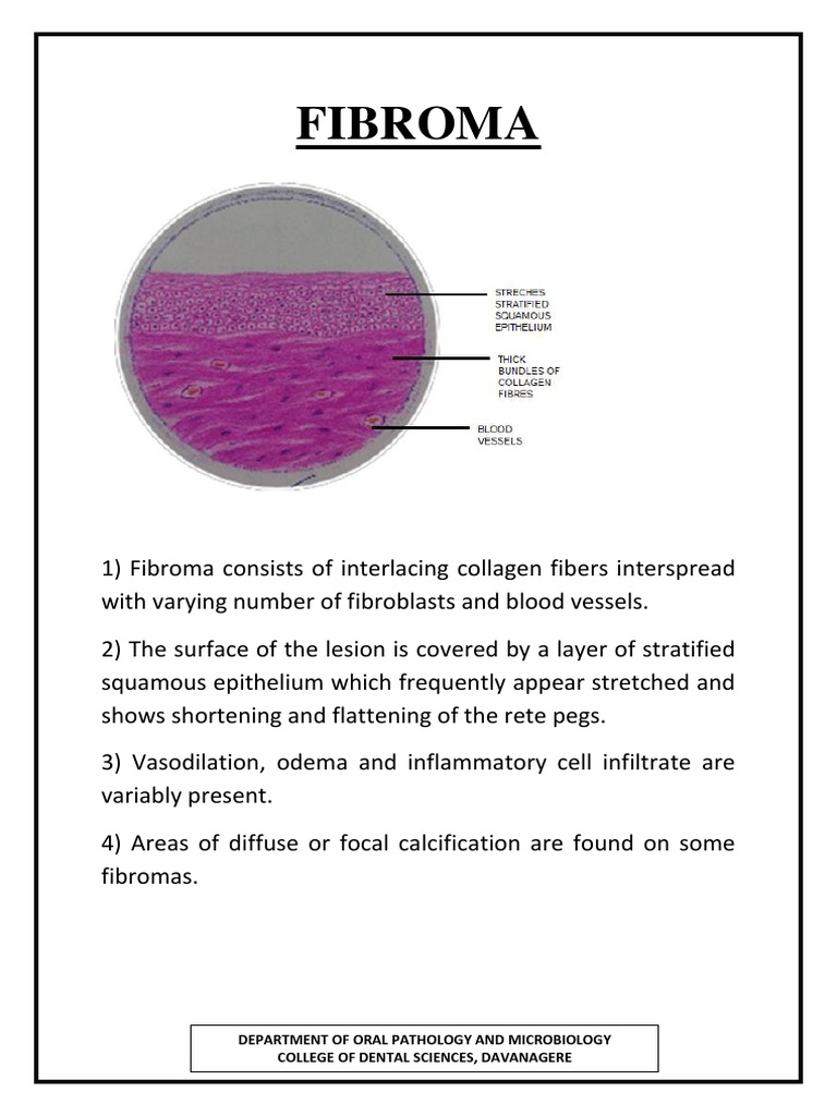 A Histopathological Analysis of the Distinguishing Features of Fibromas ...
