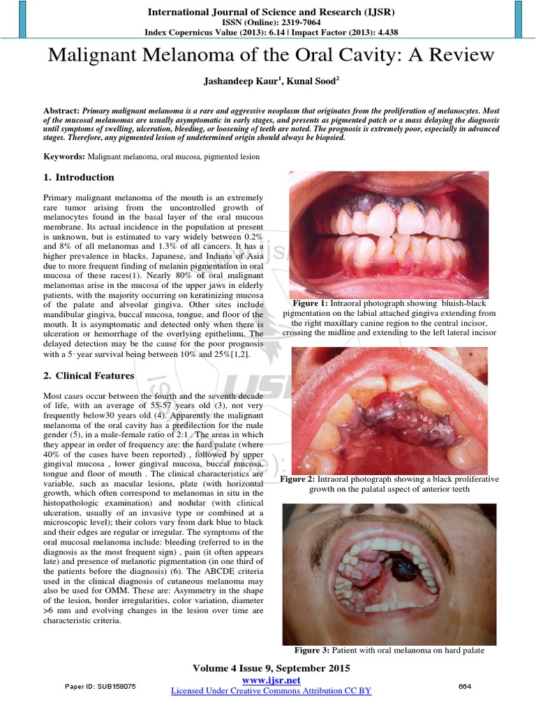 1Malignant Melanoma of The Oral Cavity A Review Melanoma Cancer