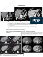 Hemangioma Hepatico