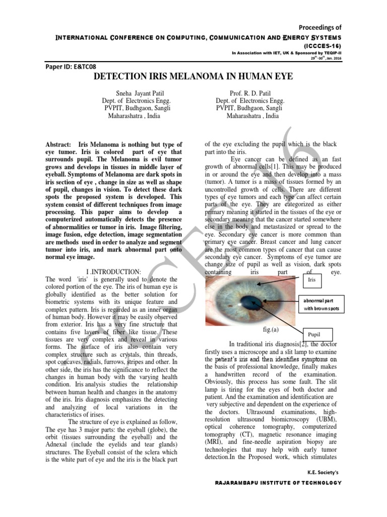 Detection Iris Melanoma in Human Eye | PDF | Human Eye | Neoplasms