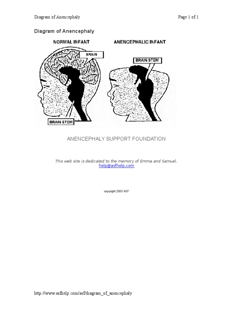 Diagram of Anencephaly | PDF