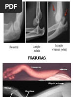 Estudos de Imagens Ortopédicas - Fraturas