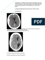 Acute Subdural Hematoma