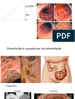 O Que é Diverticulite