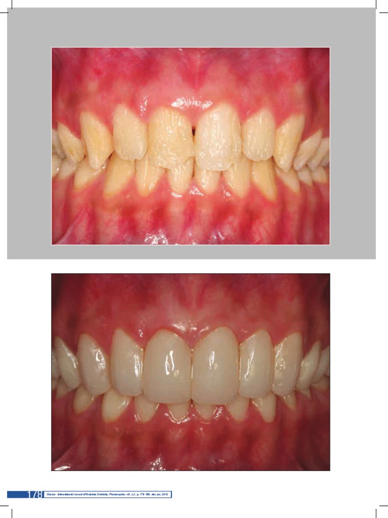 International Journal of Brazilian Dentistry