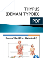 Tifoid