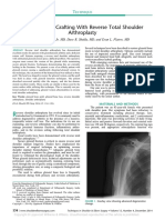 Glenoid Bone Grafting With Reverse Total Shoulder Arthroplasty