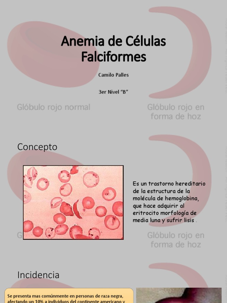 Anemia de Células Falciformes | Anemia | Especialidades ...