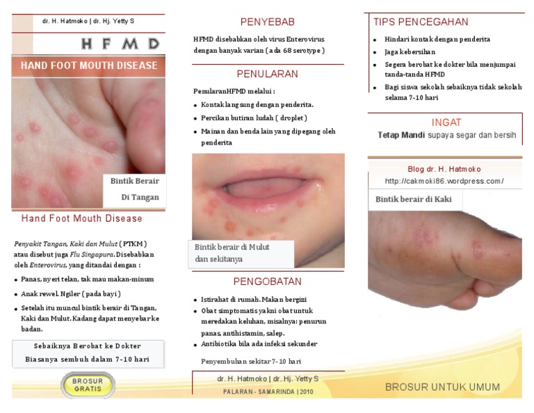 Brochure: Hand Foot and Mouth Disease | PDF