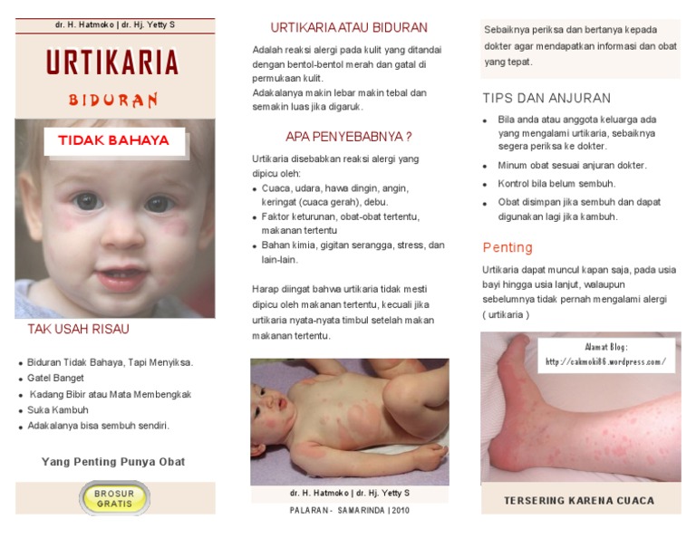 Urtikaria Biduran