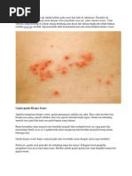Herpes Zoster Atau Cacar Api Adalah Infeksi Pada Saraf Dan Kulit Di