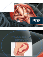 placenta-previa