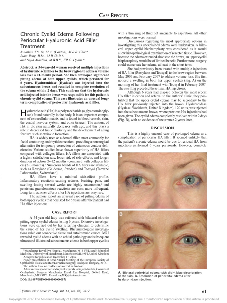 Chronic Eyelid Edema Following Periocular Hyaluronic Acid Filler
