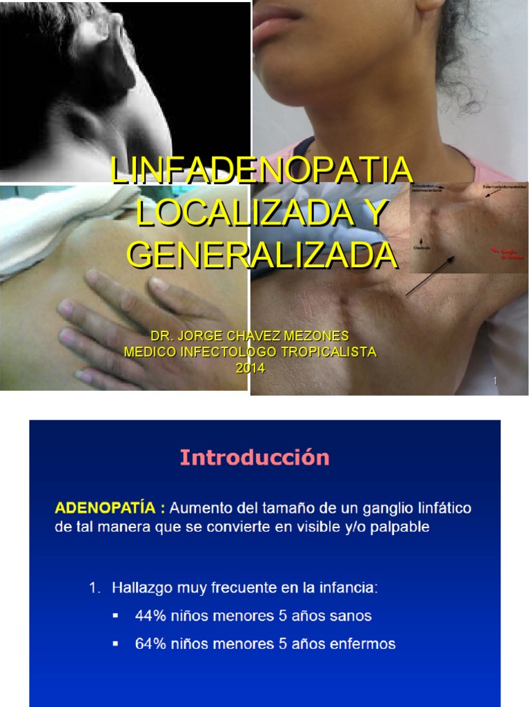 26adenopatiaupao2014 141118174513 Conversion Gate01 | PDF | Tuberculosis |  Ganglio linfático, image size:768x1024
