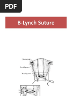 B Lynch Suture