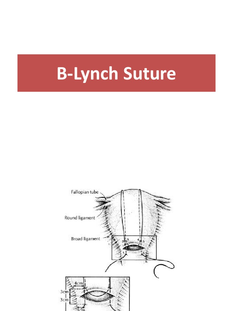 B lynch suture Surgical Suture Uterus