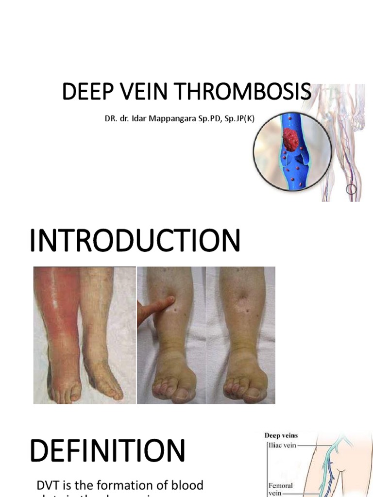 Dvt Slide Thrombosis Medical Specialties