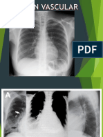 Circulación pulmonar normal y alteraciones