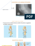 Fracturas Del Miembro Inferior