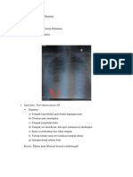 Edema Paru Bilateral Dan Vesicolithiasis