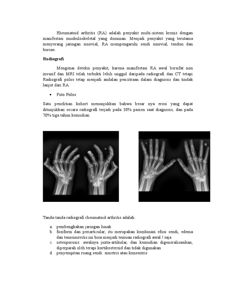 Rheumatoid Arthritis | PDF | Ilmu Sosial
