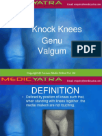 030dknockknees-120714044739-phpapp01