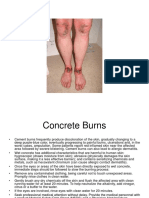 concrete and injuries.ppt