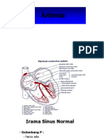 Aritmia