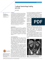 Bilateral Adrenal Haemorrhage Leading To Adrenal Crisis: Sam Mcgowan-Smyth