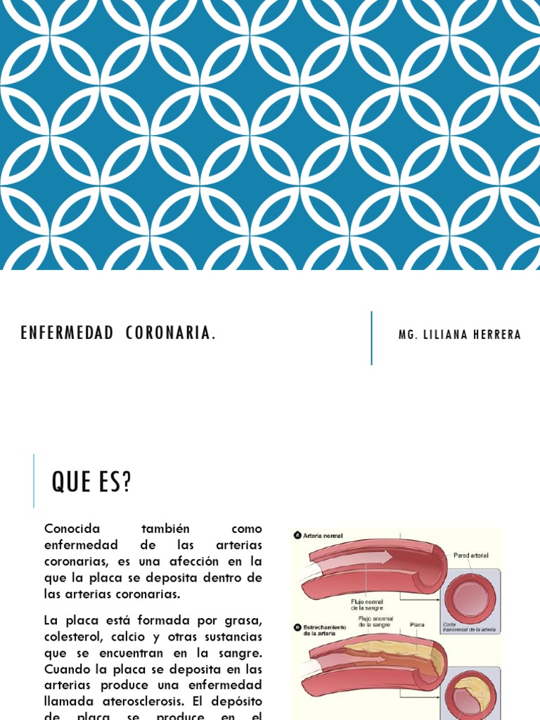 Enfermedad Coronaria PDF | PDF | Infarto de miocardio | Cardiología