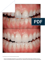 Esthetic rehabilitation of a severely worn dentition with MIPP.pdf