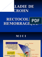 Maladie de Crohn Rectocolite Hemorragique