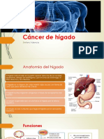 Cáncer de Hígado