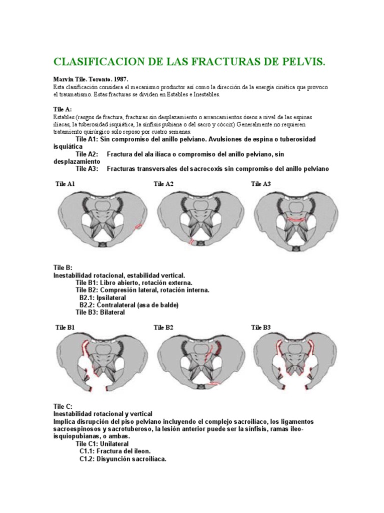 Clasificación de fracturas de pelvis Tile | PDF | Deportes | Pelvis