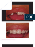 Caso Clínico - Restauração direita de dente anterior fraturado com pinos.