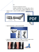 Tipo de Amputación