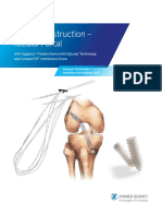 Acl Reconstruction Medial Portal With Toggleloc Fixation Device With Ziploop Technology and Compositcp Interference Screw Surgical Technique