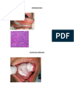 HIPERQUERATOSIS