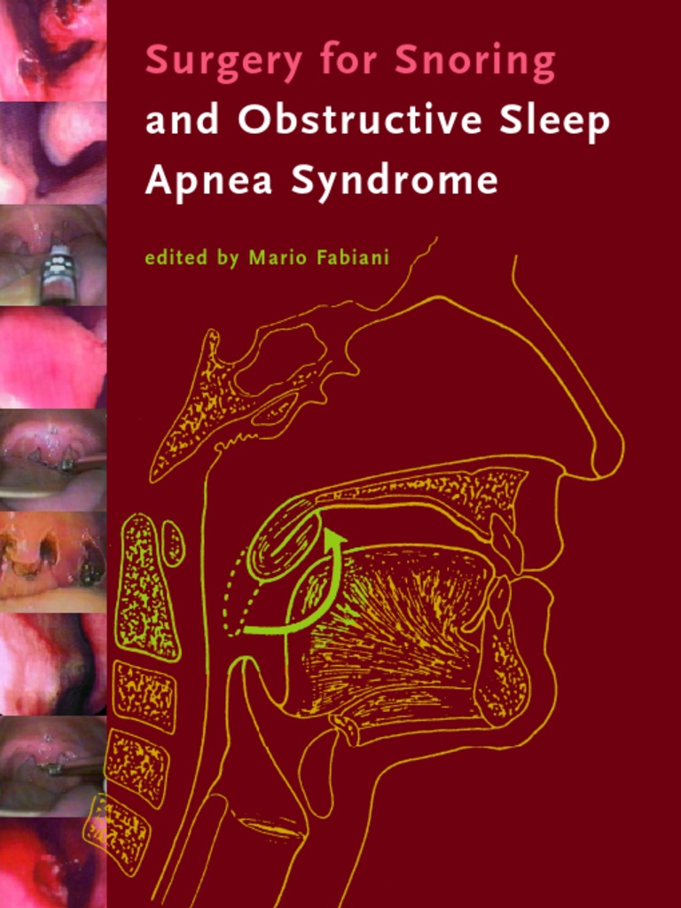 Obstructive Sleep Aponea Surgeries PDF Sleep Apnea Vein